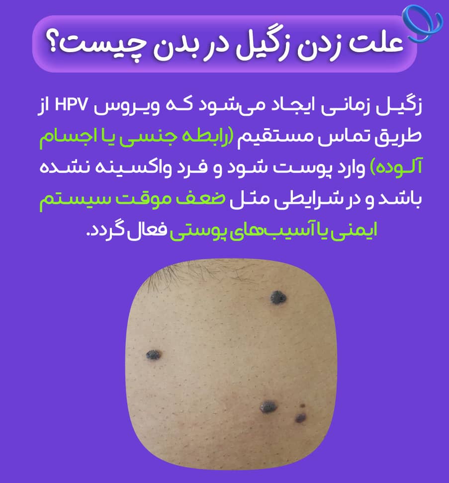 علت زدن زگیل