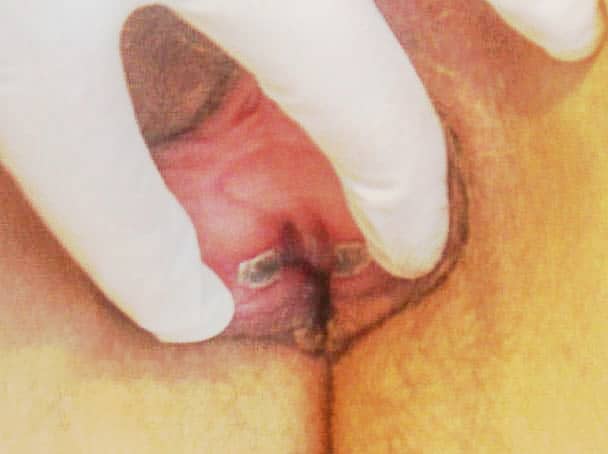 زگیل تناسلی خانمها | علائم، علت، پیشگیری و درمان مؤثر 7 عکس واضح از زگیل تناسلی زنان