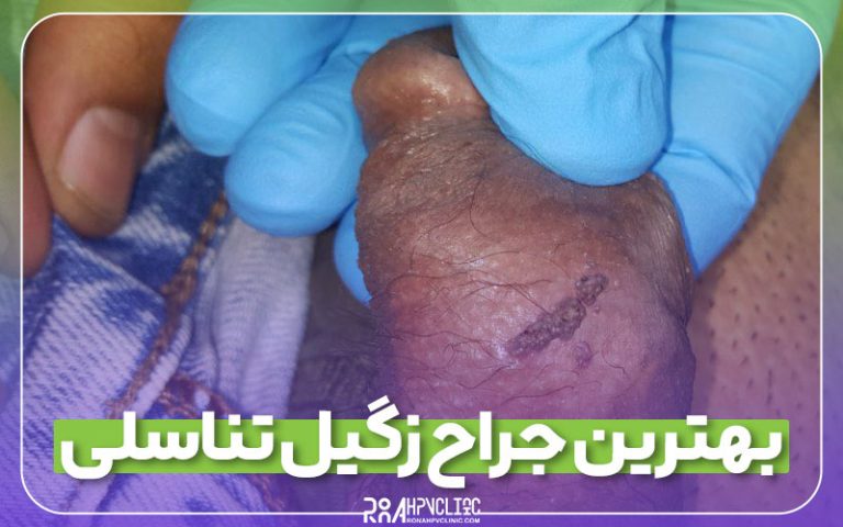 جراحی زگیل تناسلی بهترین جراح زگیل تناسلی تهران 3 بهترین جراح زگیل تناسلی