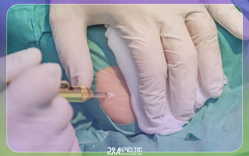 بهترین دکتر زگیل تناسلی مردان در تهران کیست و چگونه درمان را انجام می_دهد؟