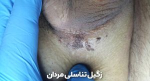 زگیل تناسلی مردان عکس 1