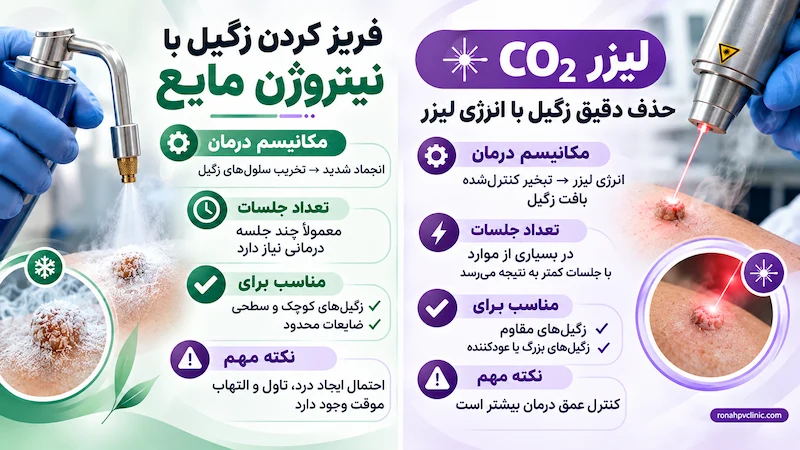 درمان زگیل تناسلی با کرایوتراپی یا لیزر؟ کدام روش بهتر است؟ 8 فریز زگیل تناسلی بهتر است یا لیزر؟ راهنمای جامع انتخاب