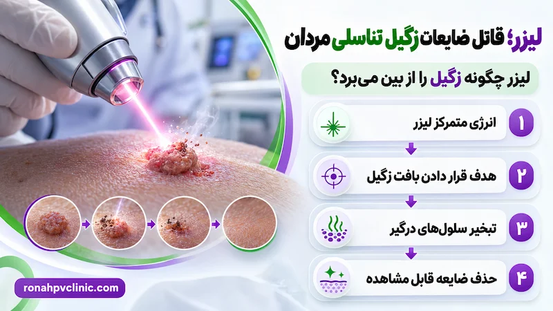 لیزر بهترین قاتل زگیل تناسلی مردان