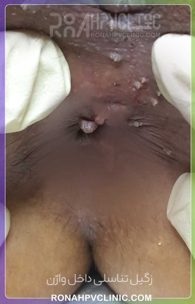 عکس زگیل تناسلی ( تصاویر واضح زگیل سرطانی و کم خطر) عکس زگیل تناسلی زنان و مردان 105 زگیل تناسلی داخل واژن
