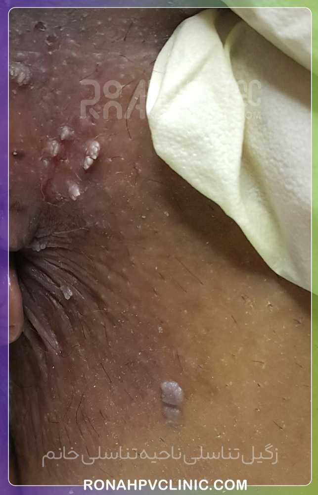 عکس زگیل تناسلی ( تصاویر واضح زگیل سرطانی و کم خطر) عکس زگیل تناسلی زنان و مردان 106 زگیل تناسلی ناحیه تناسلی زنان