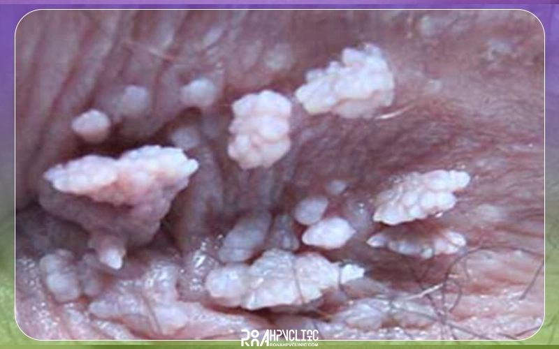 زگیل پوستی چیست و چگونه درمان میشود؟ + علت ابتلا 17 زگیل خوشه ای چگونه است؟