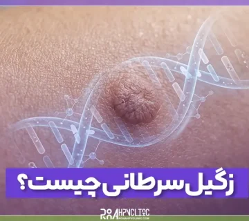 زگیل سرطانی چیست و نحوه درمان آن چگونه است؟