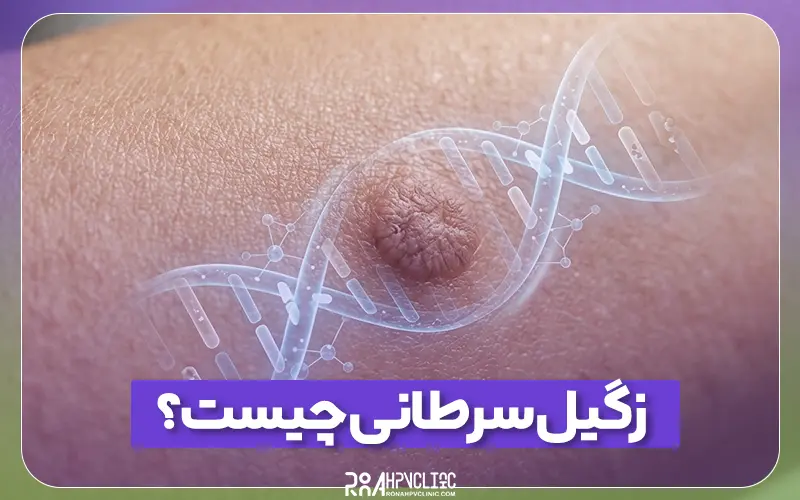 زگیل سرطانی چیست و نحوه درمان آن چگونه است؟