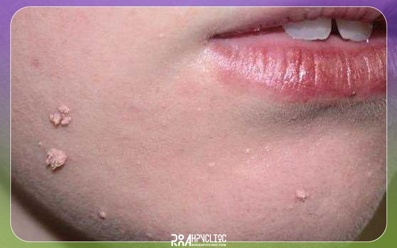 زگیل پوستی چیست و چگونه درمان میشود؟ + علت ابتلا 13 زگیل معمولی و علائم آن
