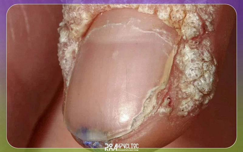 زگیل پوستی چیست و چگونه درمان میشود؟ + علت ابتلا 19 زگیل ناخن چه شکلی است؟