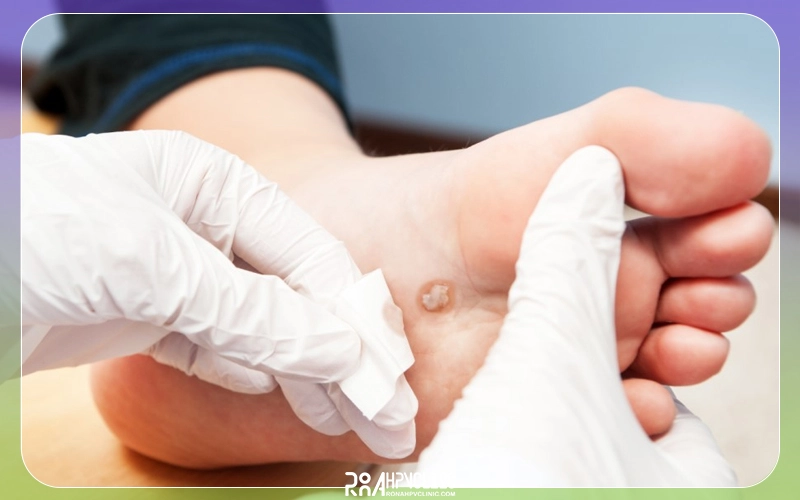 زگیل پوستی چیست و چگونه درمان میشود؟ + علت ابتلا 15 زگیل کف پا و انواع آن