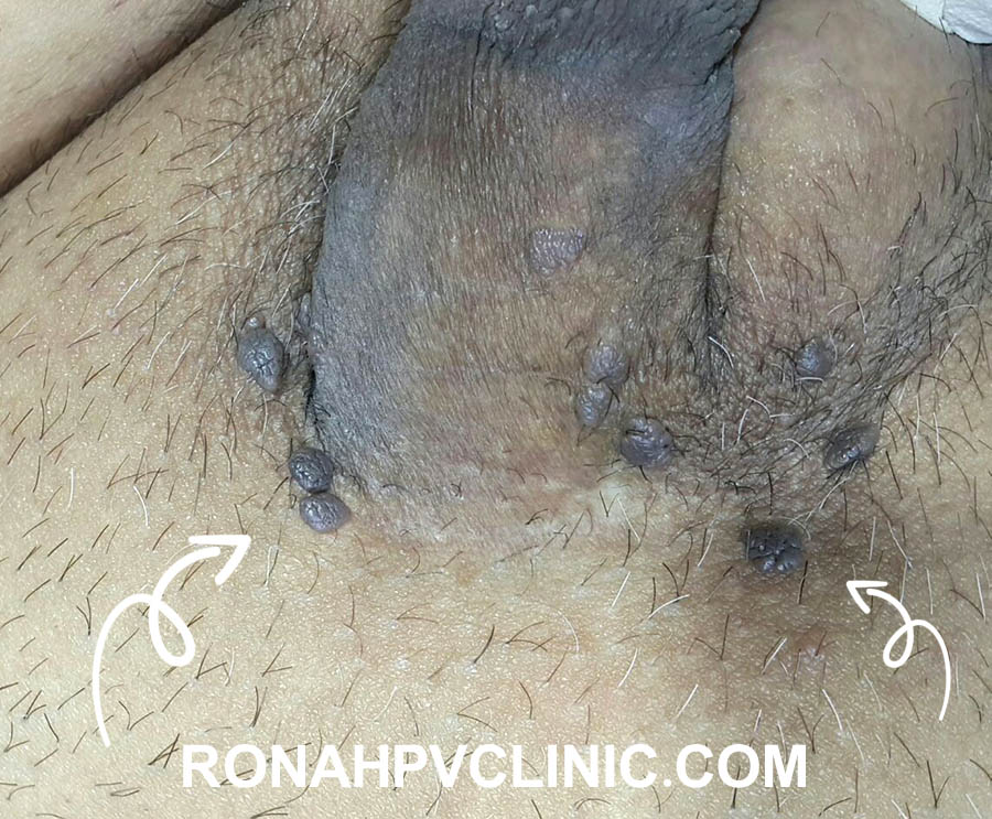 عکس زگیل تناسلی ( تصاویر واضح زگیل سرطانی و کم خطر) عکس زگیل تناسلی زنان و مردان 91 HPV