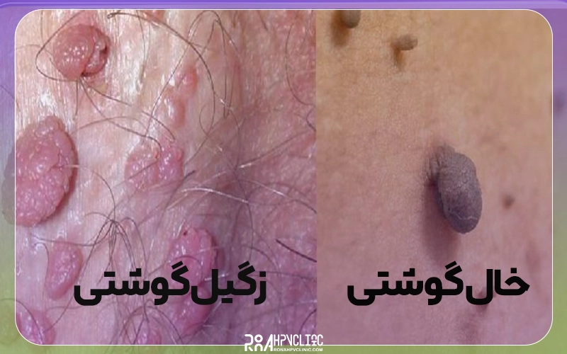 فرق خال گوشتی و زگیل گوشتی