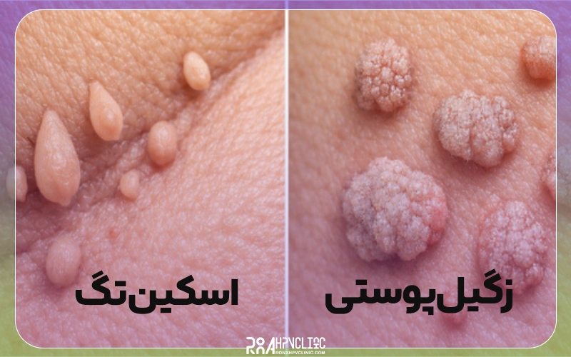 نحوه تشخیص زگیل و خال گوشتی از اسکین تگ