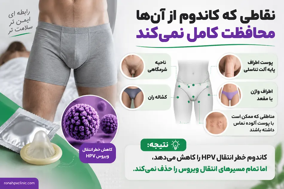 نقاط کور کاندوم برای جلوگیری از زگیل تناسلی
