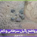 تصاویر واضح زگیل سرطانی