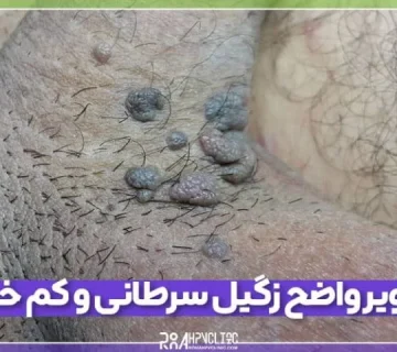 تصاویر واضح زگیل سرطانی