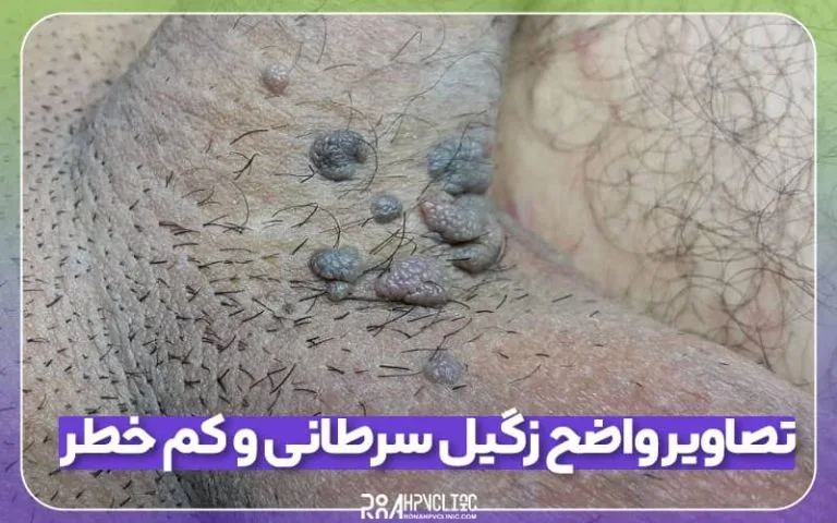عکس زگیل تناسلی ( تصاویر واضح زگیل سرطانی و کم خطر) عکس زگیل تناسلی زنان و مردان 54 تصاویر واضح زگیل سرطانی