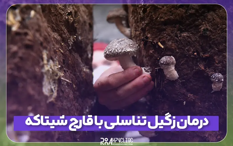 نحوه درمان زگیل تناسلی با قارچ شیتاکه