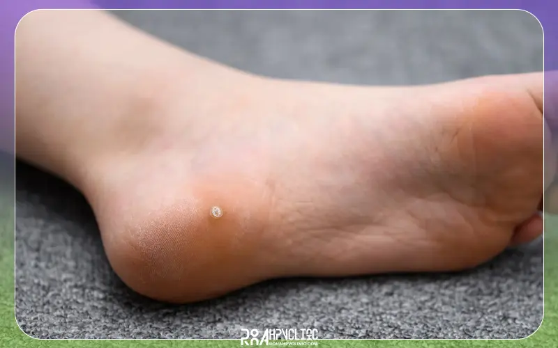 آیا زگیل در کودکان خطرناک است؟