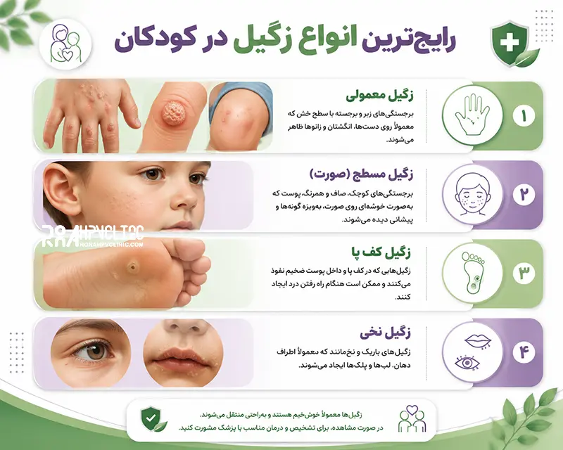 انواع زگیل در کودکان با عکس
