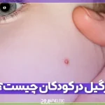 زگیل در کودکان چیست و چه نشانه هایی دارد