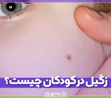زگیل در کودکان چیست و چه نشانه هایی دارد