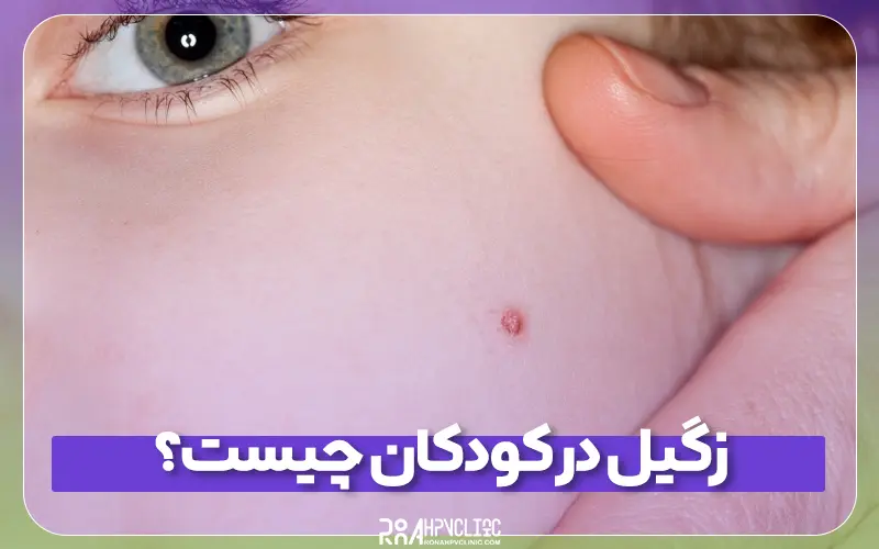 کلینیک hpv رونا 182 زگیل در کودکان چیست و چه نشانه هایی دارد