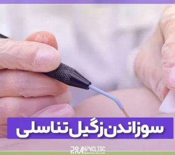 سوزاندن زگیل تناسلی چیست و چگونه انجام می شود
