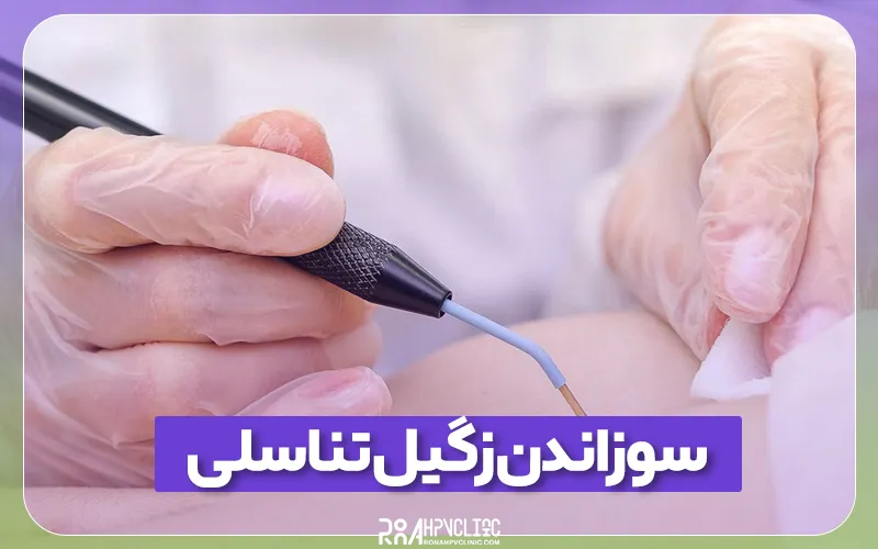 کلینیک hpv رونا 182 سوزاندن زگیل تناسلی چیست و چگونه انجام می شود