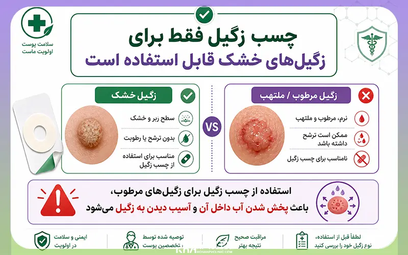 چسب زگیل چیست و چگونه زگیل را درمان میکند؟🩹 + نحوه استفاده 4 نکات مهم و نحوه استفاده از چسب زگیل
