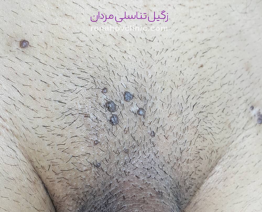 عکس زگیل تناسلی ( تصاویر واضح زگیل سرطانی و کم خطر) عکس زگیل تناسلی زنان و مردان 57 زگیل تناسلی مردان