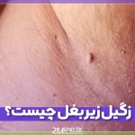 زگیل زیر بغل چیست و چه علائمی دارد؟