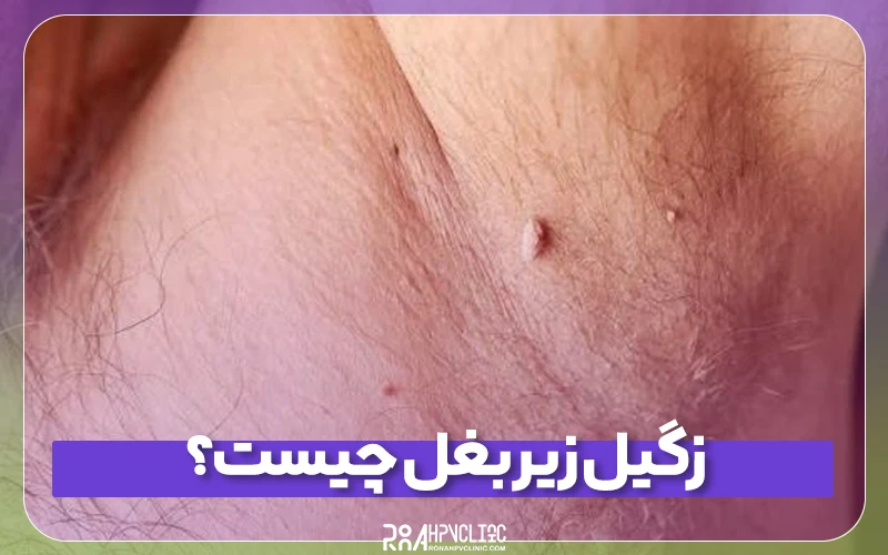 زگیل زیر بغل چیست و چه علائمی دارد؟