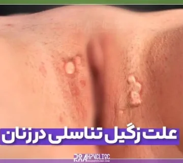 علت زگیل تناسلی در زنان