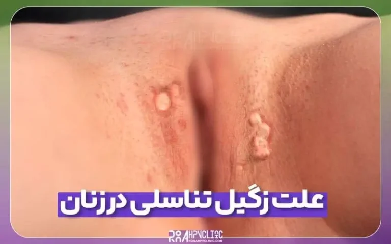 علت زگیل تناسلی در زنان