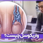 واریکوسل چیست و چه علائمی دارد؟