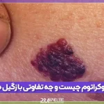 آنژیوکراتوم چیست و چه تفاوتی با زگیل تناسلی دارد؟