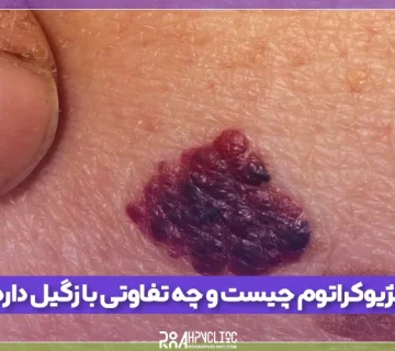 آنژیوکراتوم چیست و چه تفاوتی با زگیل تناسلی دارد؟