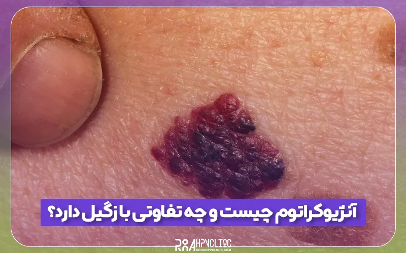 آنژیوکراتوم چیست و چه تفاوتی با زگیل تناسلی دارد؟