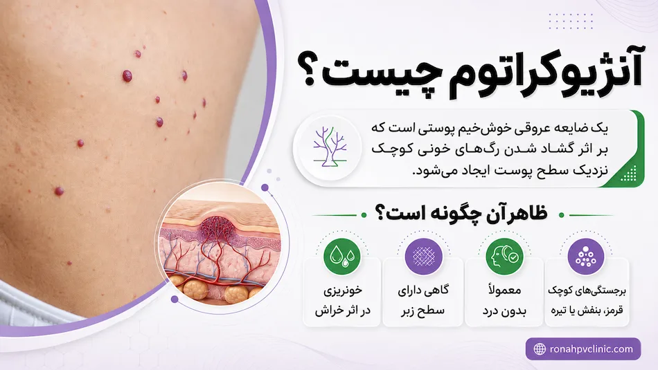 آنژیوکراتوم چیست و چه تفاوتی با زگیل تناسلی دارد؟ 7 آنژیوکراتوم چیست و چه علائمی دارد؟