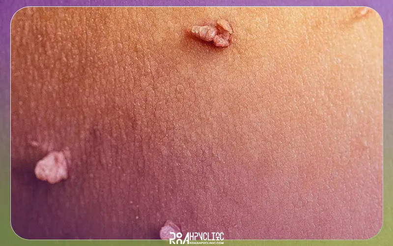 تفاوت مولوسکوم و زگیل تناسلی چیست؟ 7 تفاوت زگیل تناسلی و مولوسکوم