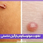 تفاوت مولوسکوم و زگیل تناسلی را بشناسید