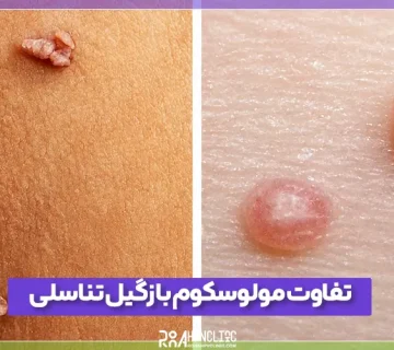 تفاوت مولوسکوم و زگیل تناسلی را بشناسید