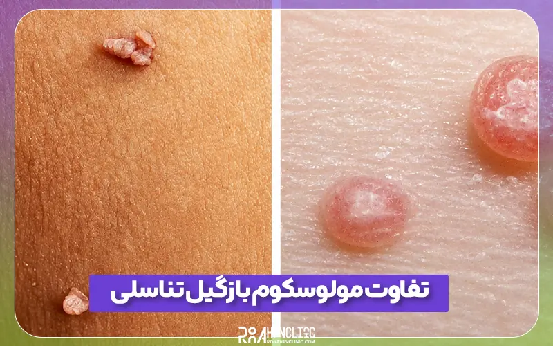 تفاوت مولوسکوم و زگیل تناسلی را بشناسید
