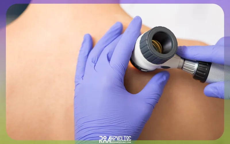 آنژیوکراتوم چیست و چه تفاوتی با زگیل تناسلی دارد؟ 11 راه تشخیص آنژیوکراتوم چیست و نحوه درمان آن