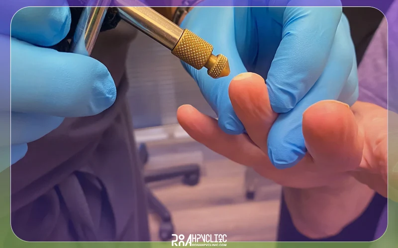 فریز کردن زگیل چیست و چگونه انجام میشود؟ 7 فریز کردن زگیل تناسلی چگونه انجام می شود؟