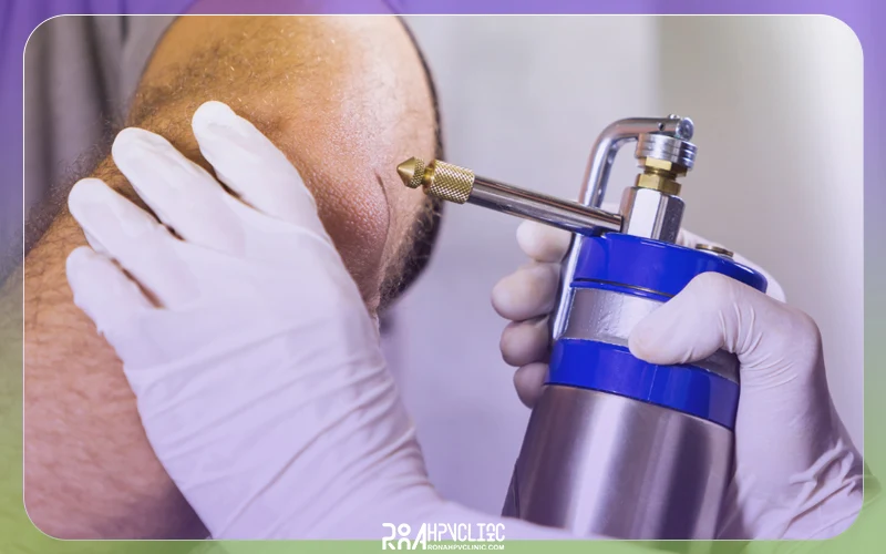 فریز کردن زگیل چیست و چگونه انجام میشود؟ 9 مزایا و عوارض فریز زگیل تناسلی