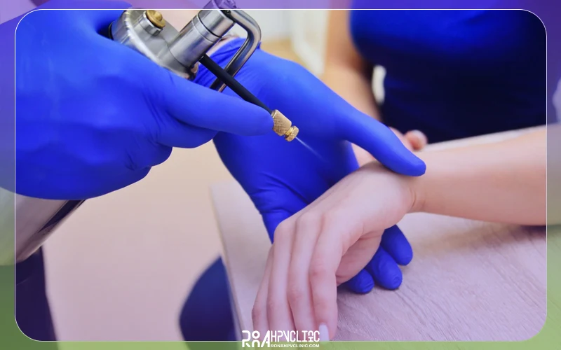 فریز کردن زگیل چیست و چگونه انجام میشود؟ 11 هزینه کرایو و فریز کردن زگیل تناسلی