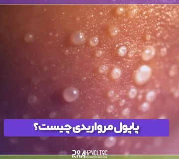 پاپول مرواریدی چیست و چه علائمی دارد؟